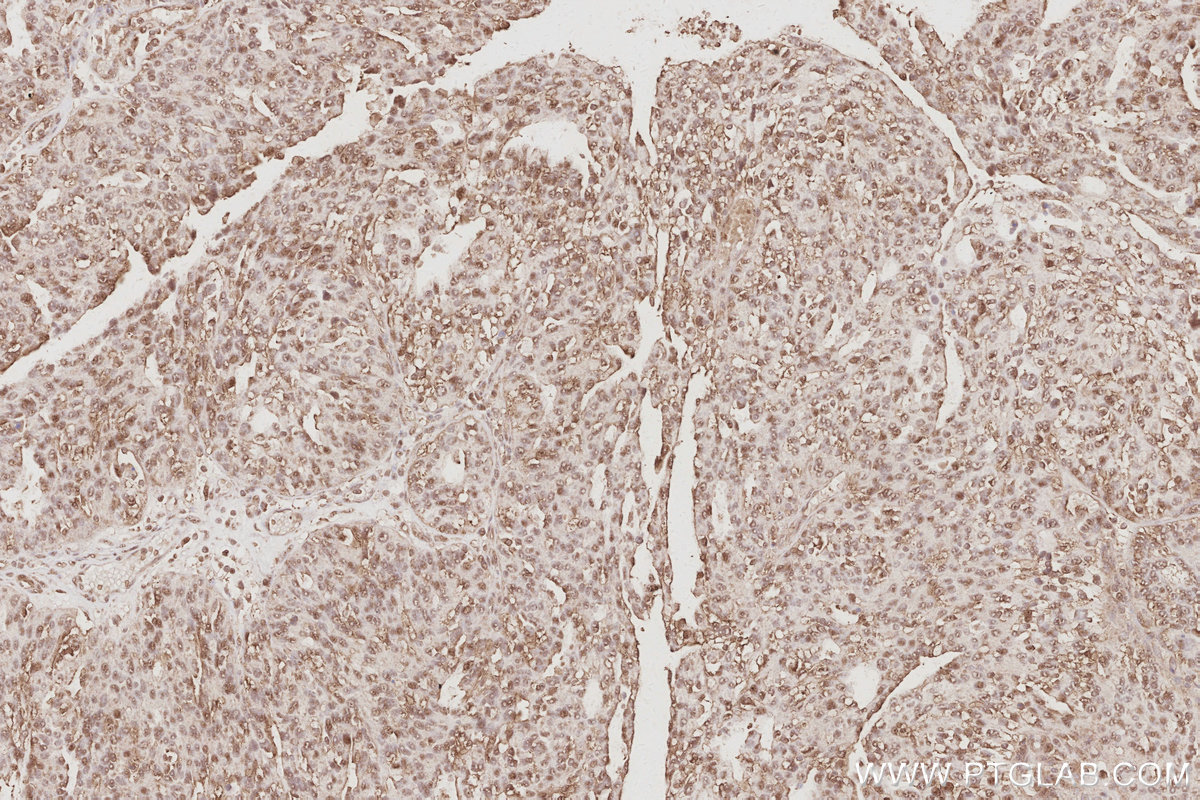 Immunohistochemical analysis of paraffin-embedded human ovary cancer tissue slide using KHC3088 (ARFGEF1 IHC Kit).