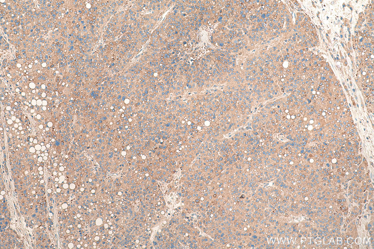 Immunohistochemical analysis of paraffin-embedded human liver cancer tissue slide using KHC0865 (ARFIP1 IHC Kit).