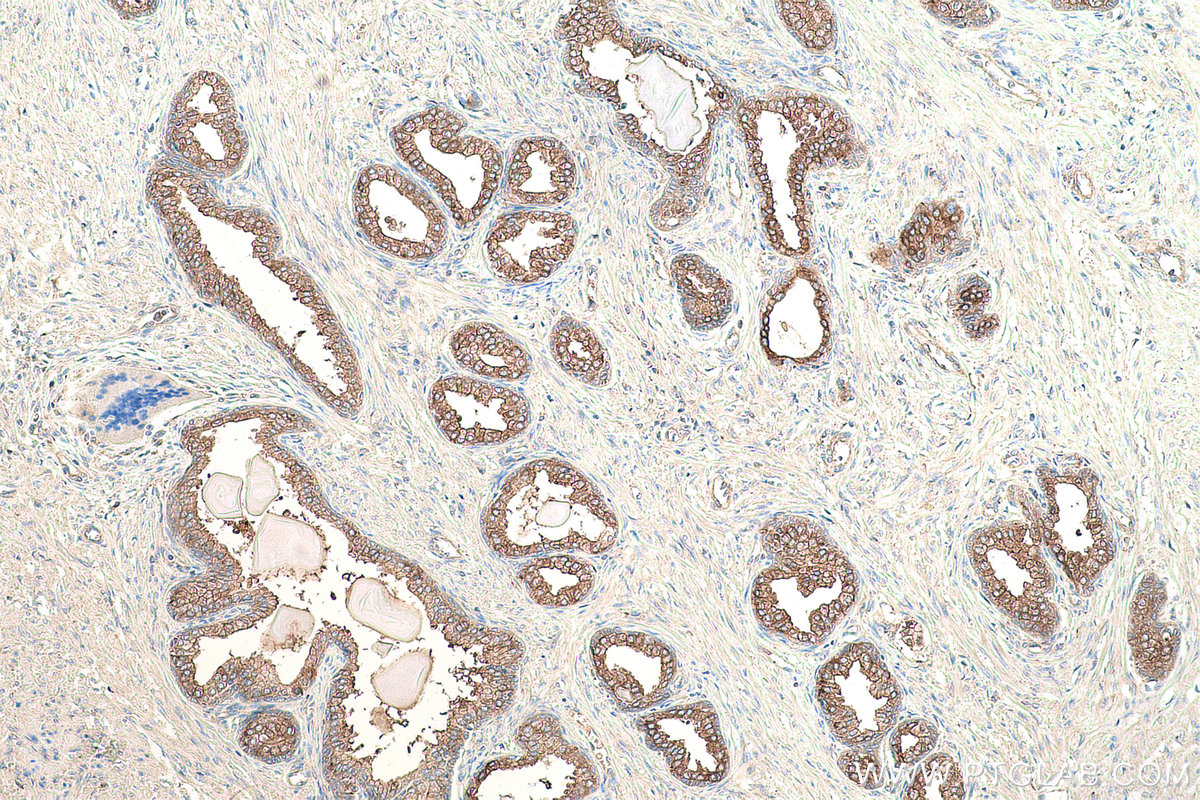 Immunohistochemical analysis of paraffin-embedded human prostate cancer tissue slide using KHC0865 (ARFIP1 IHC Kit).