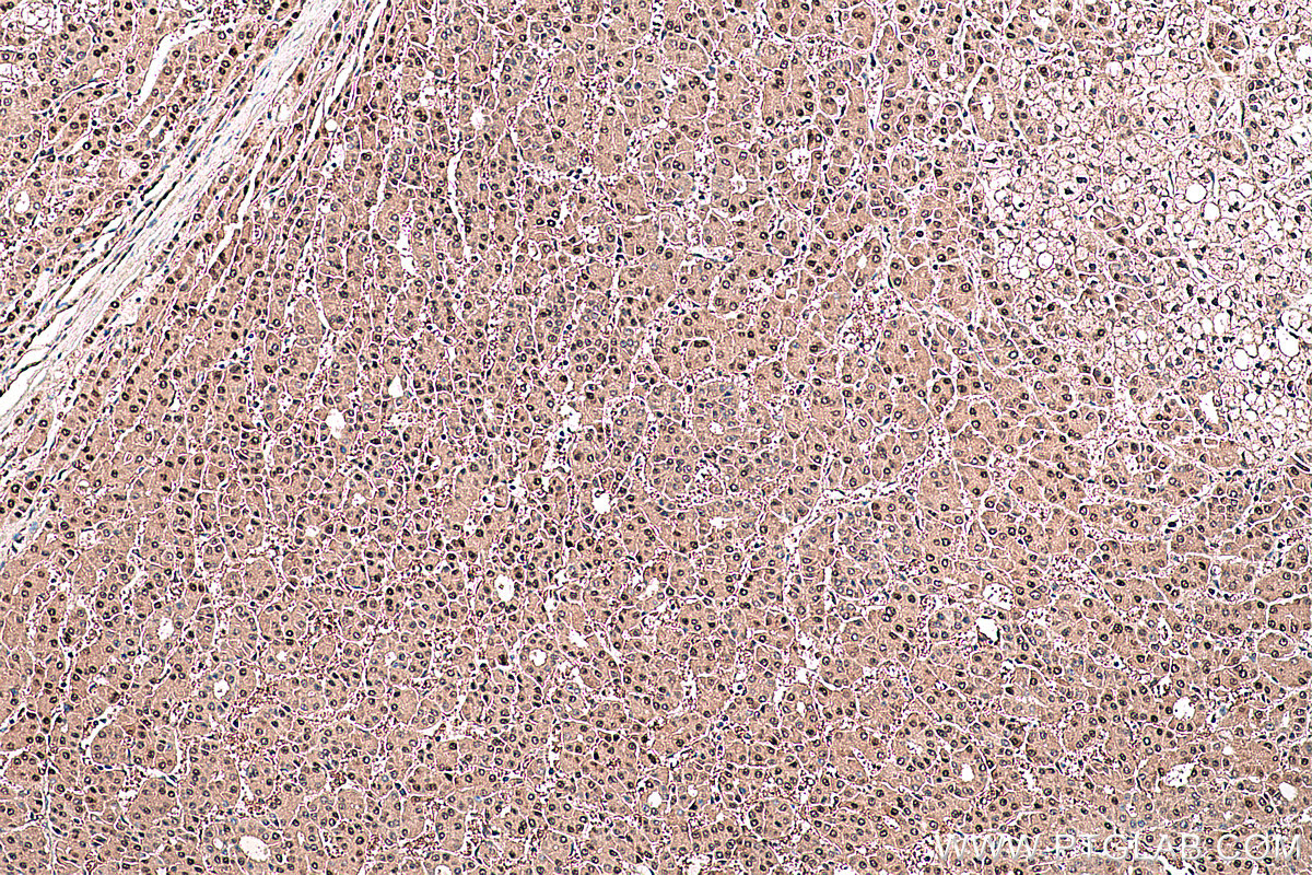 Immunohistochemical analysis of paraffin-embedded human liver cancer tissue slide using KHC0383 (ARG1 IHC Kit).