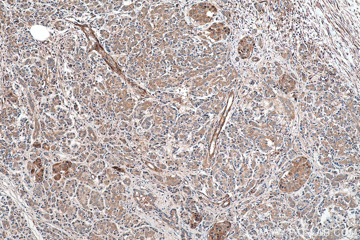 Immunohistochemical analysis of paraffin-embedded human pancreas cancer tissue slide using KHC0717 (ARHGAP1 IHC Kit).