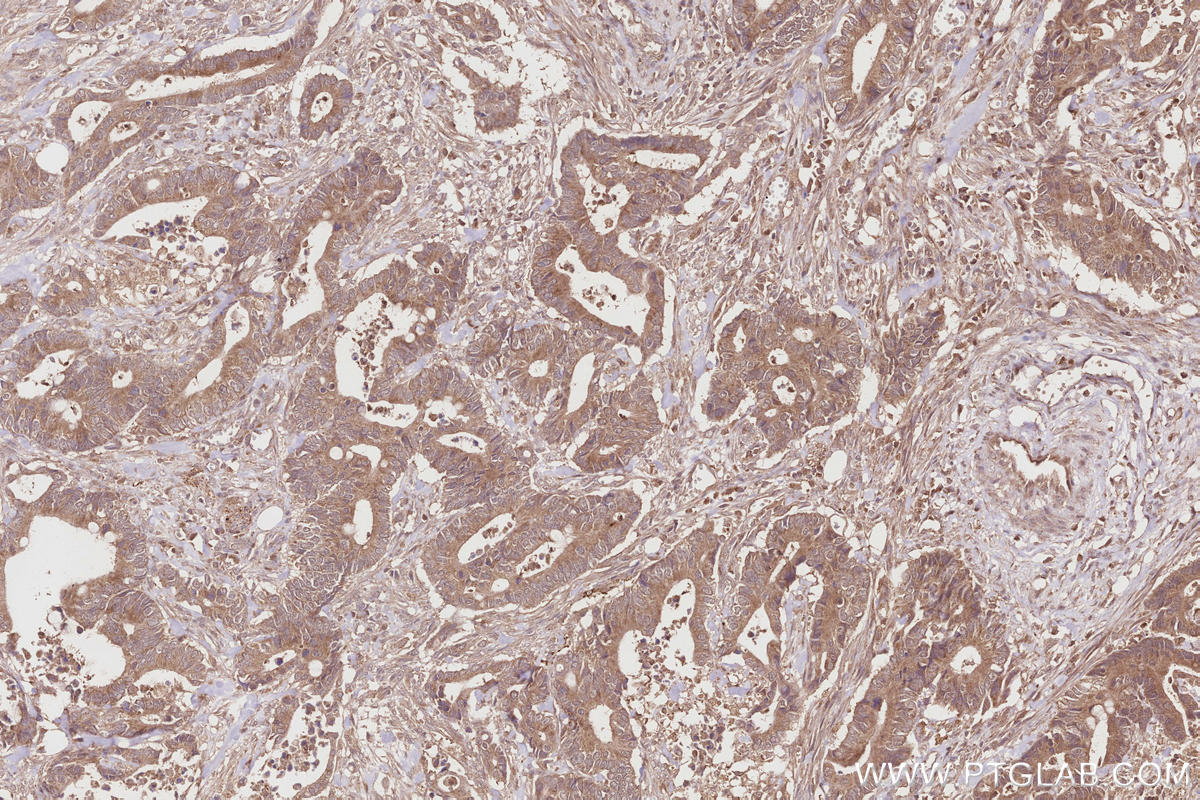 Immunohistochemical analysis of paraffin-embedded human rectal cancer tissue slide using KHC2857 (ARHGAP9 IHC Kit).