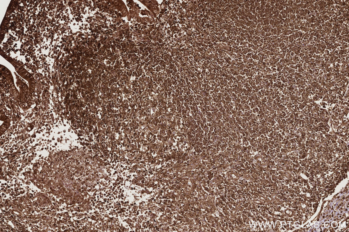 Immunohistochemical analysis of paraffin-embedded human appendicitis tissue slide using KHC2764 (ARHGEF1 IHC Kit). Immunohistochemical analysis of paraffin-embedded human appendicitis tissue slide using KHC2764 (ARHGEF1 IHC Kit).