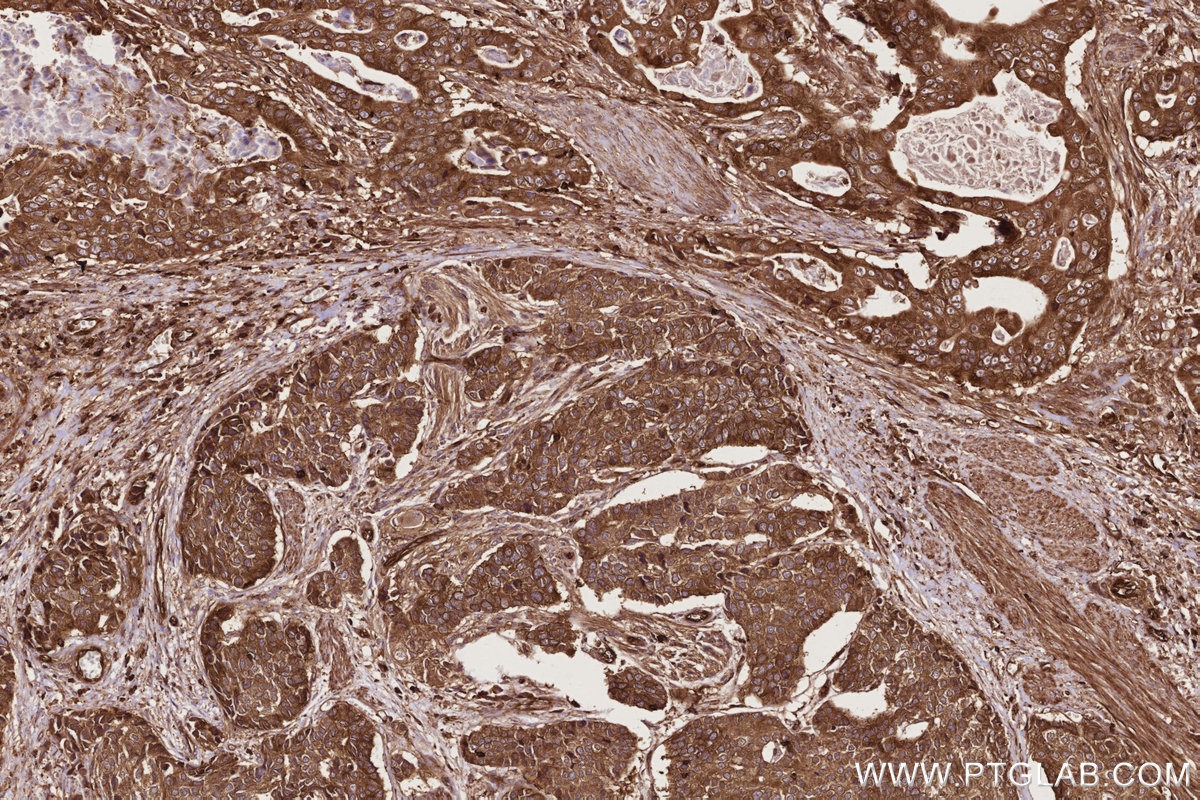 Immunohistochemical analysis of paraffin-embedded human stomach cancer tissue slide using KHC2764 (ARHGEF1 IHC Kit). Immunohistochemical analysis of paraffin-embedded human stomach cancer tissue slide using KHC2764 (ARHGEF1 IHC Kit).