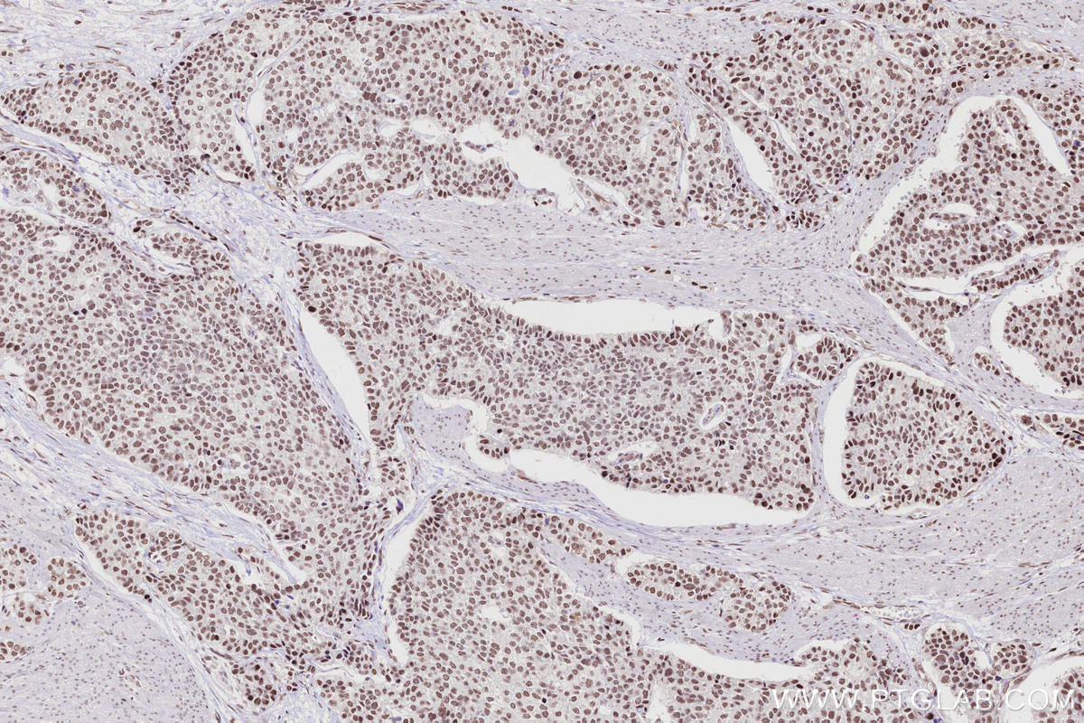 Immunohistochemical analysis of paraffin-embedded human stomach cancer tissue slide using KHC2695 (ARID1B IHC Kit).