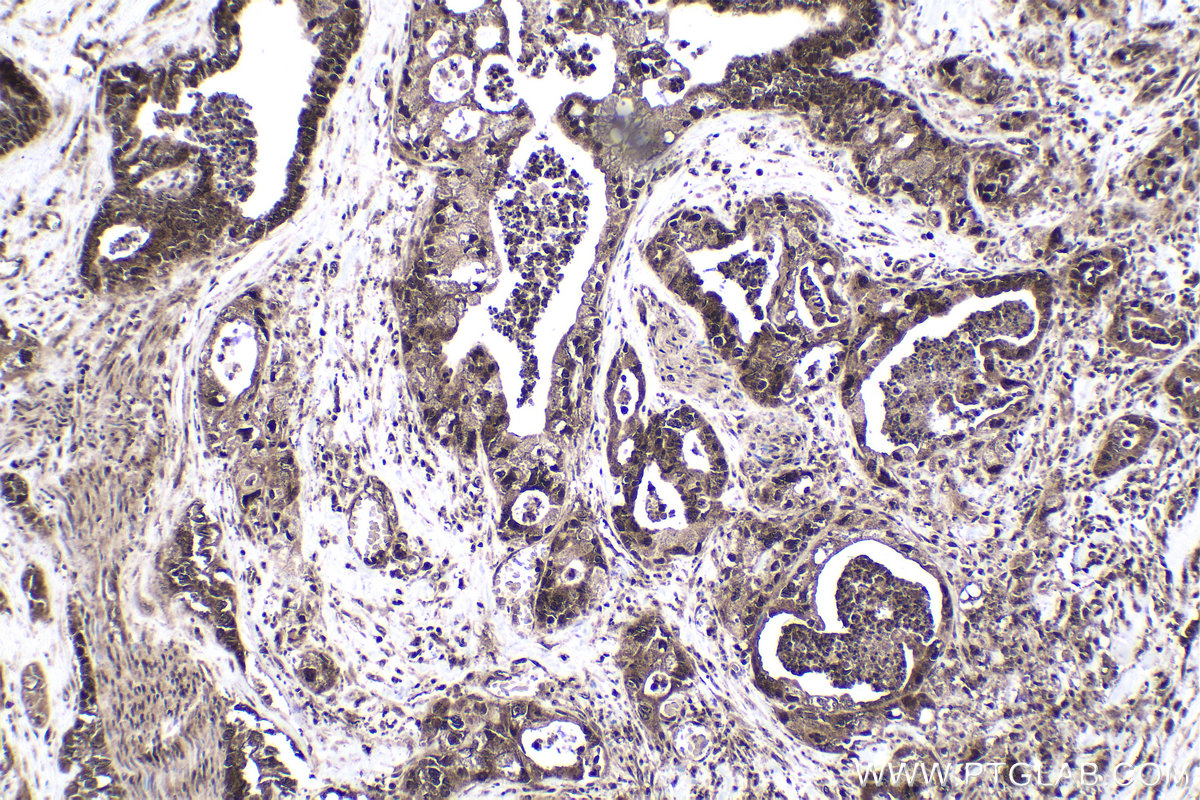 Immunohistochemical analysis of paraffin-embedded human pancreas cancer tissue slide using KHC1772 (ARID4B IHC Kit).