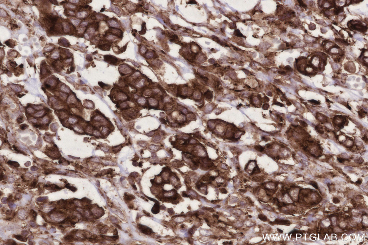 Immunohistochemical analysis of paraffin-embedded human stomach cancer tissue slide using KHC2779 (ARL8A/ARL8B IHC Kit).