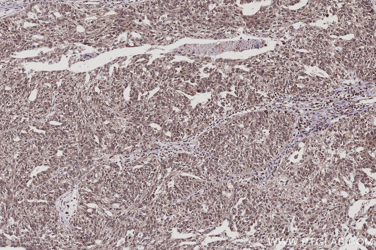 Immunohistochemical analysis of paraffin-embedded human ovary cancer tissue slide using KHC3120 (ARMCX3 IHC Kit). Immunohistochemical analysis of paraffin-embedded human ovary cancer tissue slide using KHC3120 (ARMCX3 IHC Kit).