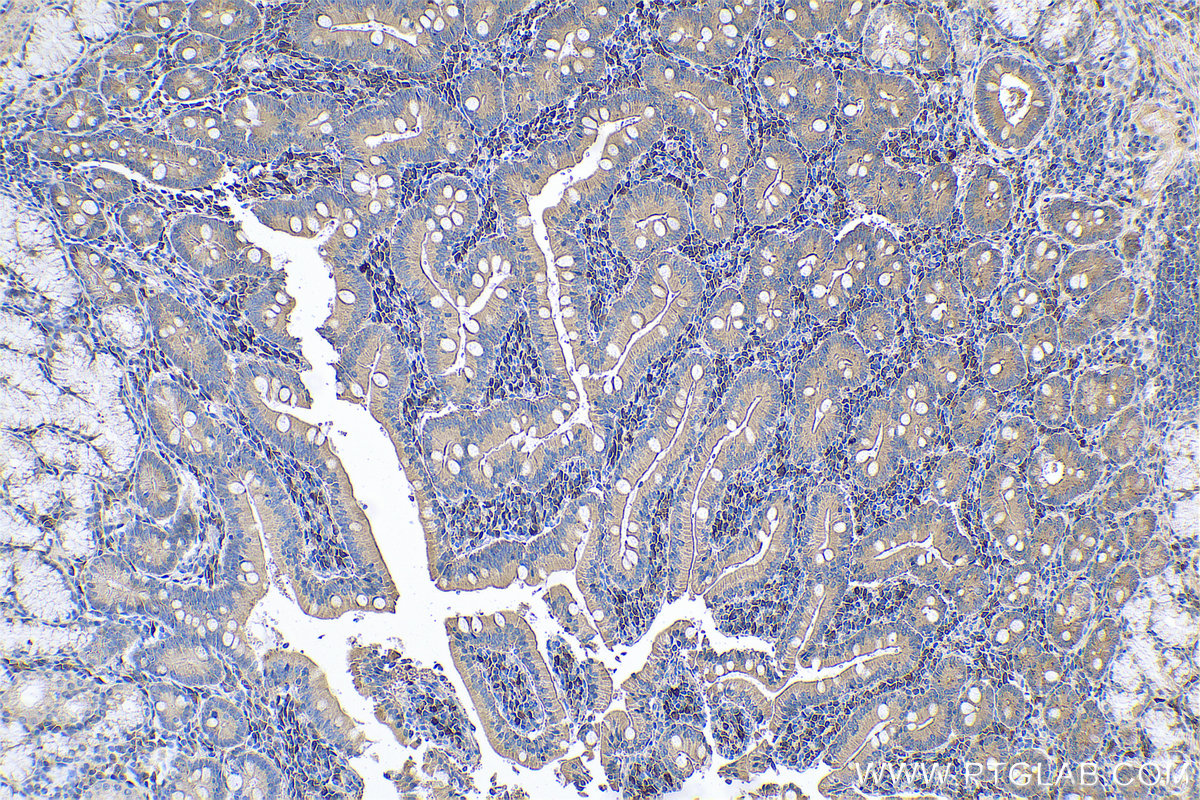 Immunohistochemical analysis of paraffin-embedded human stomach cancer tissue slide using KHC0686 (ARMET IHC Kit).