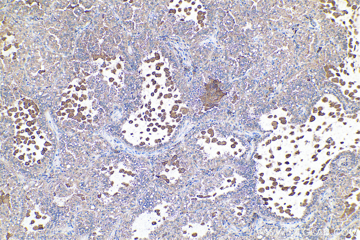 Immunohistochemical analysis of paraffin-embedded human lung cancer tissue slide using KHC0686 (ARMET IHC Kit).