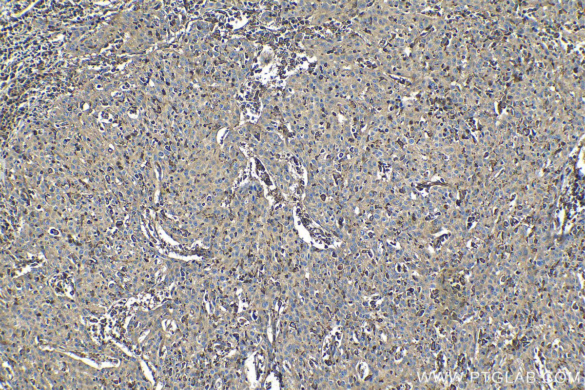 Immunohistochemical analysis of paraffin-embedded human cervical cancer tissue slide using KHC1233 (ARP3 IHC Kit).