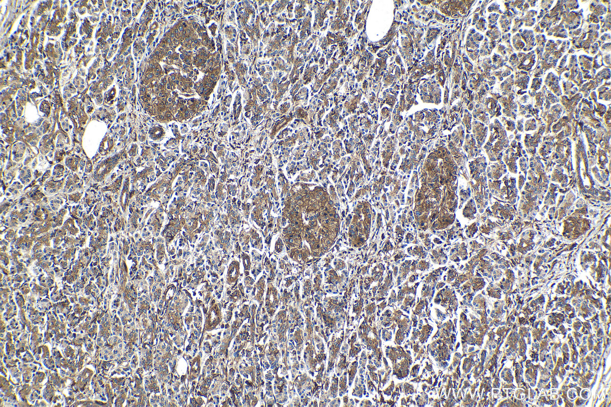 Immunohistochemical analysis of paraffin-embedded human pancreas cancer tissue slide using KHC1233 (ARP3 IHC Kit).