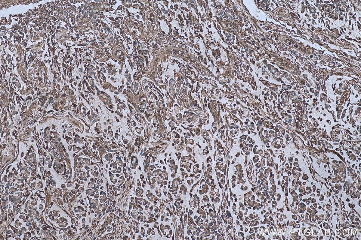 Immunohistochemical analysis of paraffin-embedded human colon cancer tissue slide using KHC0622 (ARPC1B IHC Kit).