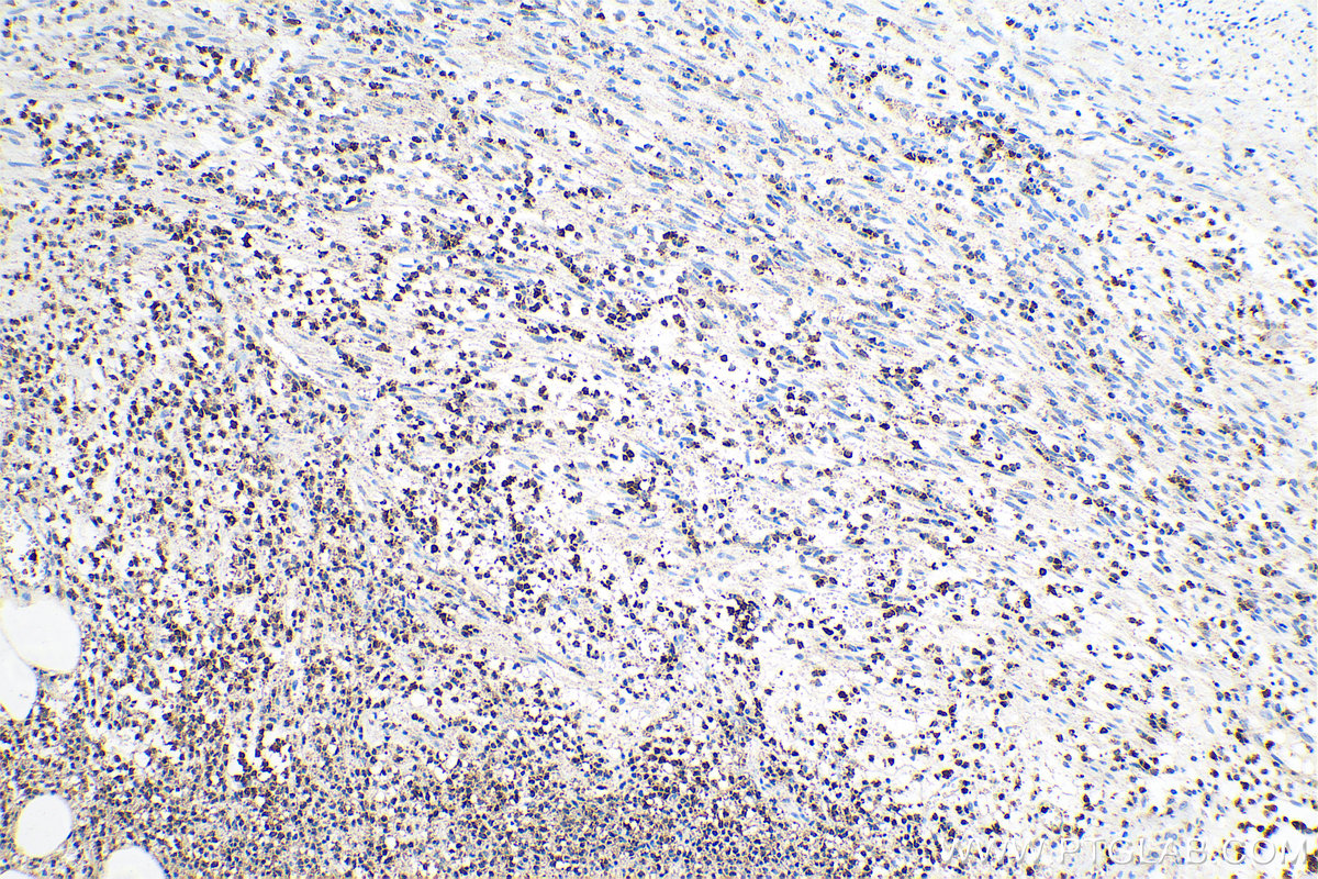 Immunohistochemical analysis of paraffin-embedded human appendicitis tissue slide using KHC0704 (ARPC3 IHC Kit).