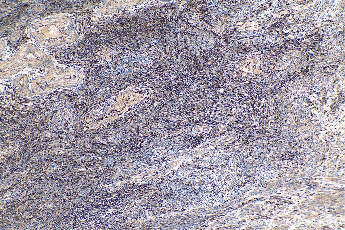 Immunohistochemical analysis of paraffin-embedded human cervical cancer tissue slide using KHC0704 (ARPC3 IHC Kit).