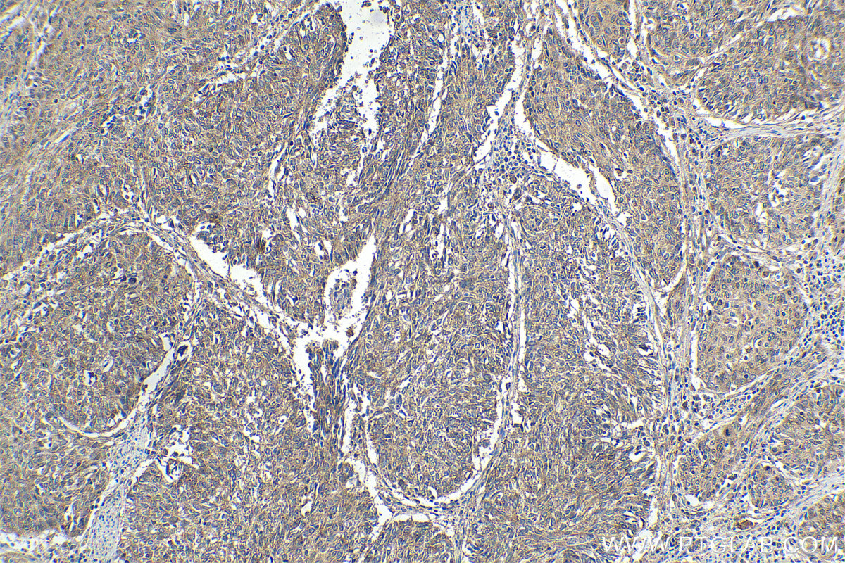 Immunohistochemical analysis of paraffin-embedded human cervical cancer tissue slide using KHC1636 (ARPC4 IHC Kit).