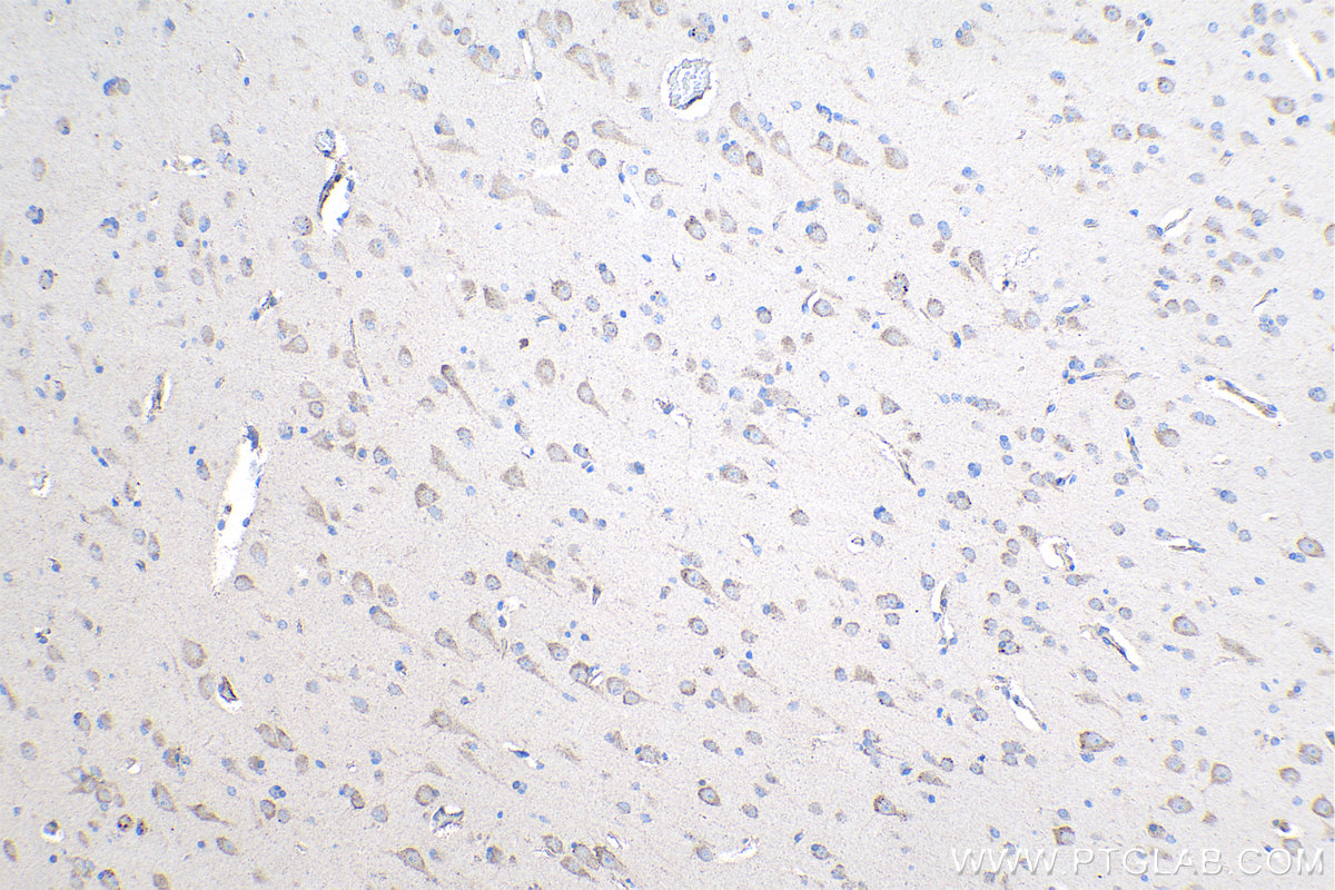 Immunohistochemical analysis of paraffin-embedded human gliomas tissue slide using KHC1039 (ARPP19 IHC Kit).