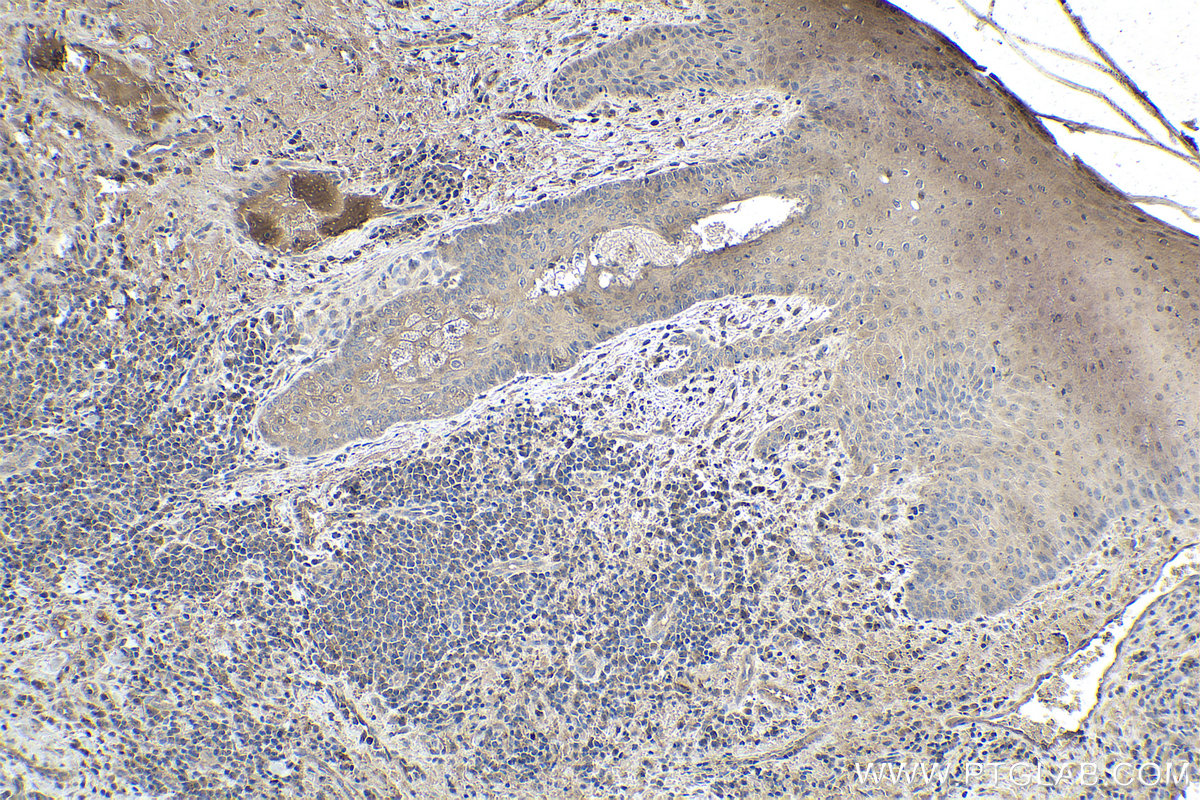 Immunohistochemical analysis of paraffin-embedded human skin cancer tissue slide using KHC1714 (ASAH1 IHC Kit).