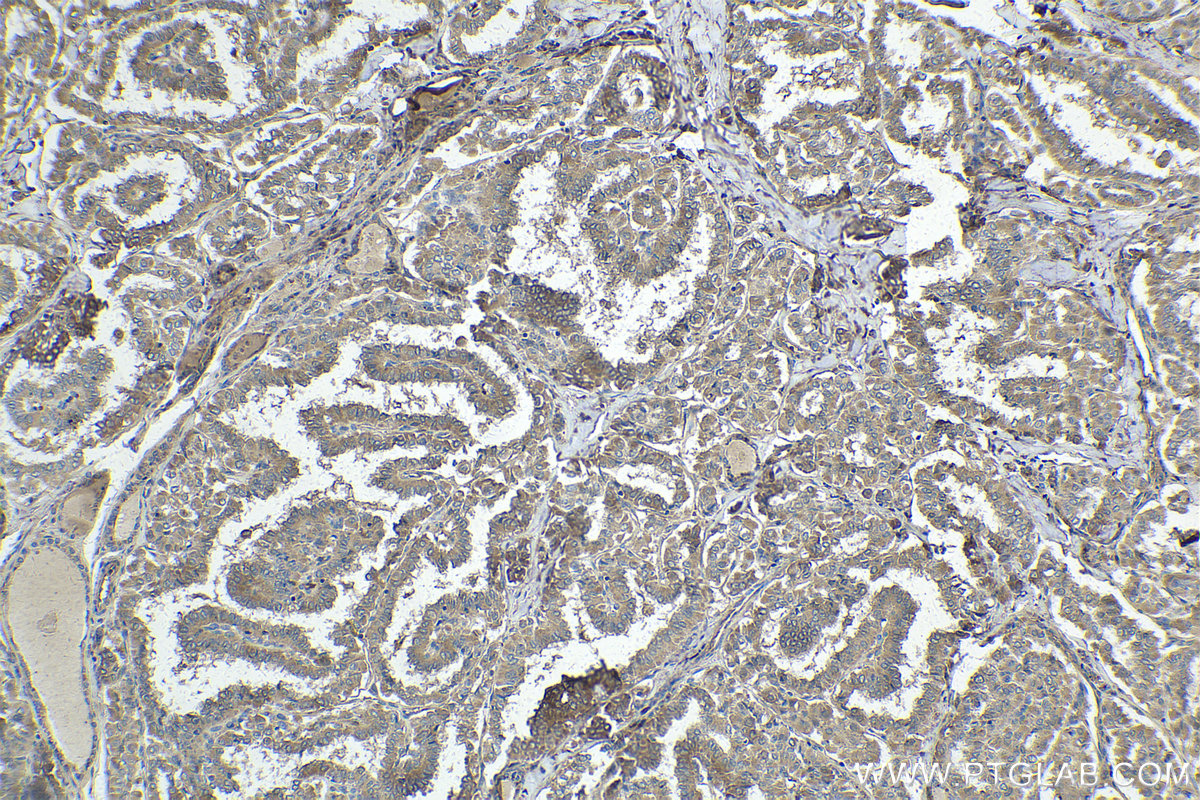 Immunohistochemical analysis of paraffin-embedded human thyroid cancer tissue slide using KHC1714 (ASAH1 IHC Kit).
