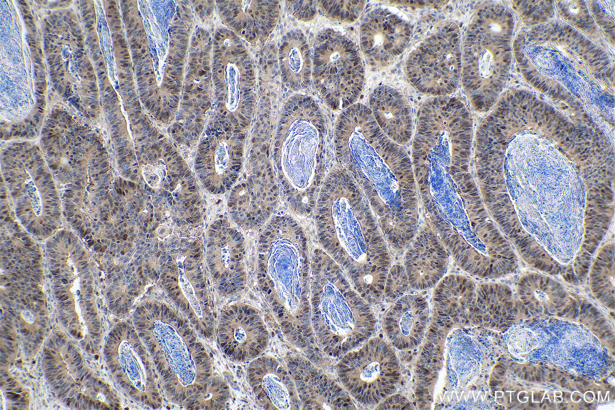 Immunohistochemical analysis of paraffin-embedded human colon cancer tissue slide using KHC0880 (ASF1B IHC Kit).