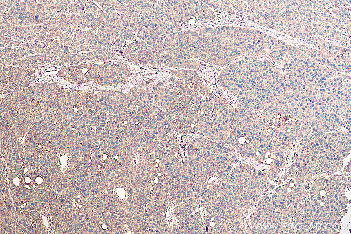 Immunohistochemical analysis of paraffin-embedded human liver cancer tissue slide using KHC0384 (ASGR1 IHC Kit).