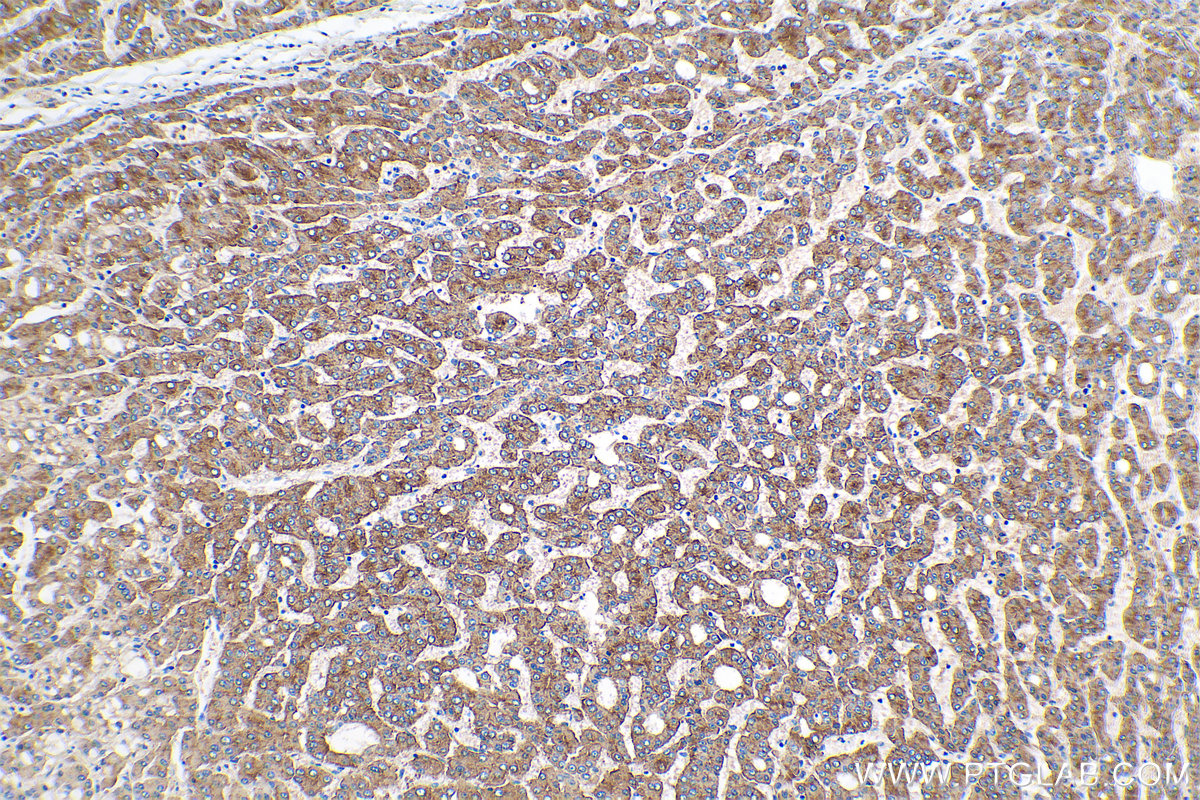 Immunohistochemical analysis of paraffin-embedded human liver cancer tissue slide using KHC0385 (ASGR2 IHC Kit).