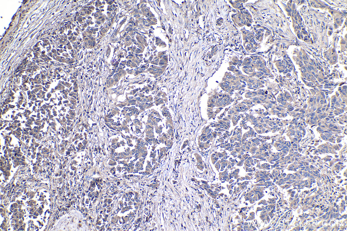 Immunohistochemical analysis of paraffin-embedded human lung cancer tissue slide using KHC1086 (ASPM IHC Kit).