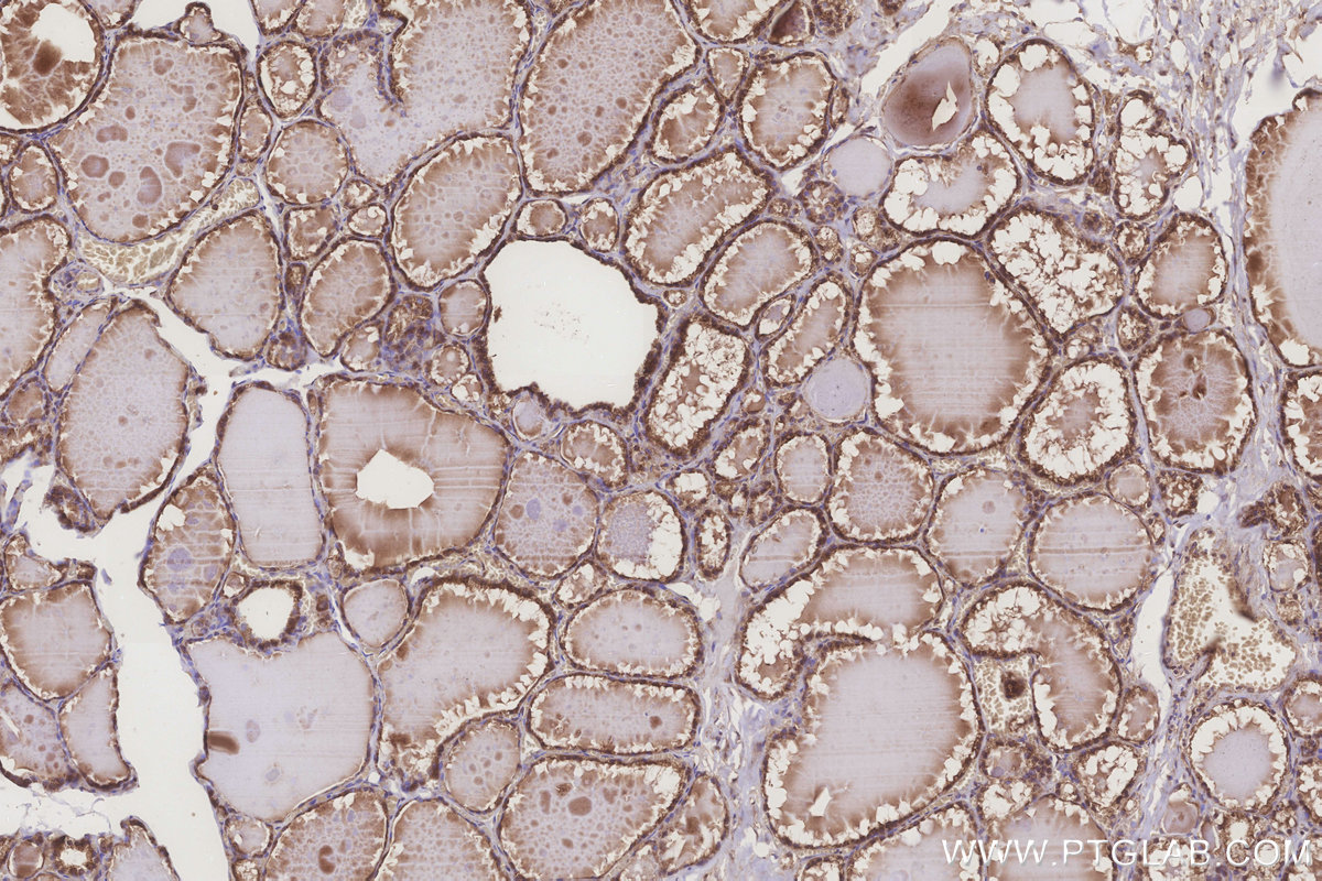 Immunohistochemical analysis of paraffin-embedded human thyroid cancer tissue slide using KHC3259 (ATG2A IHC Kit).