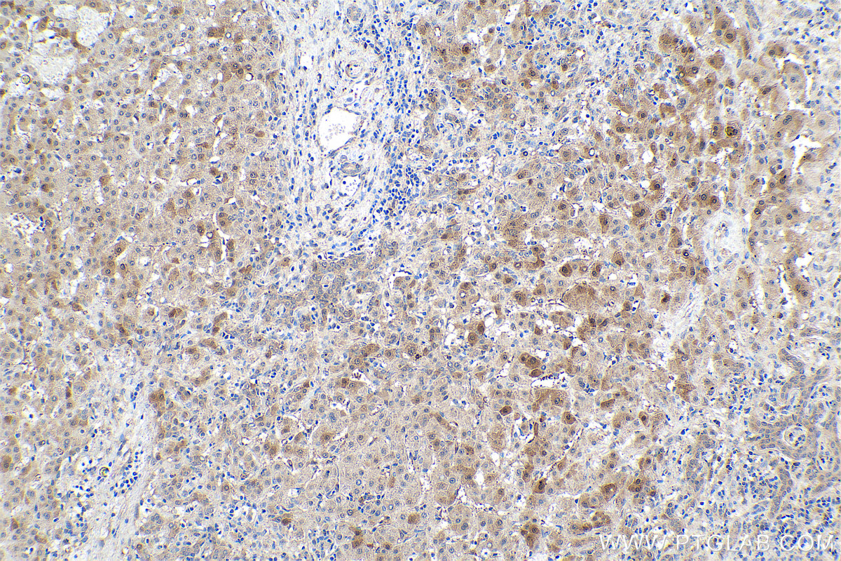 Immunohistochemical analysis of paraffin-embedded human liver cancer tissue slide using KHC0932 (ATOX1 IHC Kit).