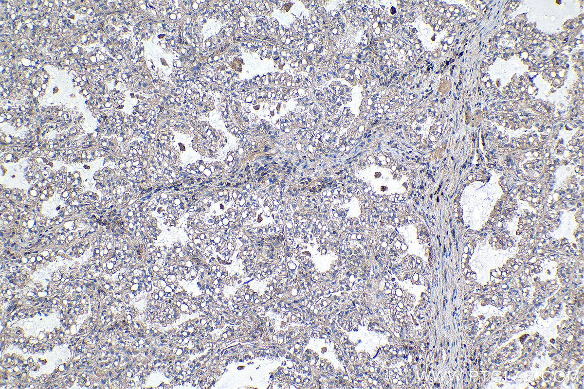 Immunohistochemical analysis of paraffin-embedded human lung cancer tissue slide using KHC1116 (ATP1B3 IHC Kit).