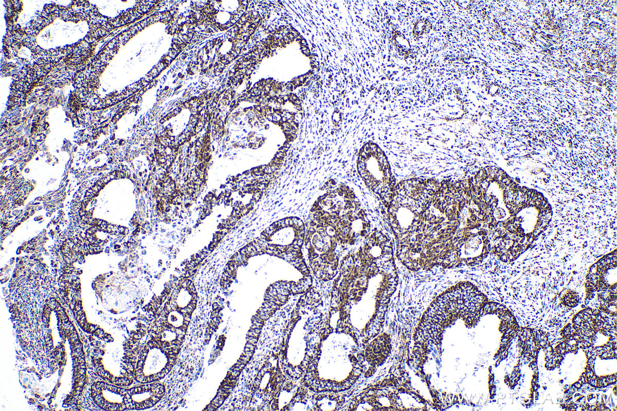 Immunohistochemical analysis of paraffin-embedded human ovary tumor tissue slide using KHC0530 (ATP5A1 IHC Kit).