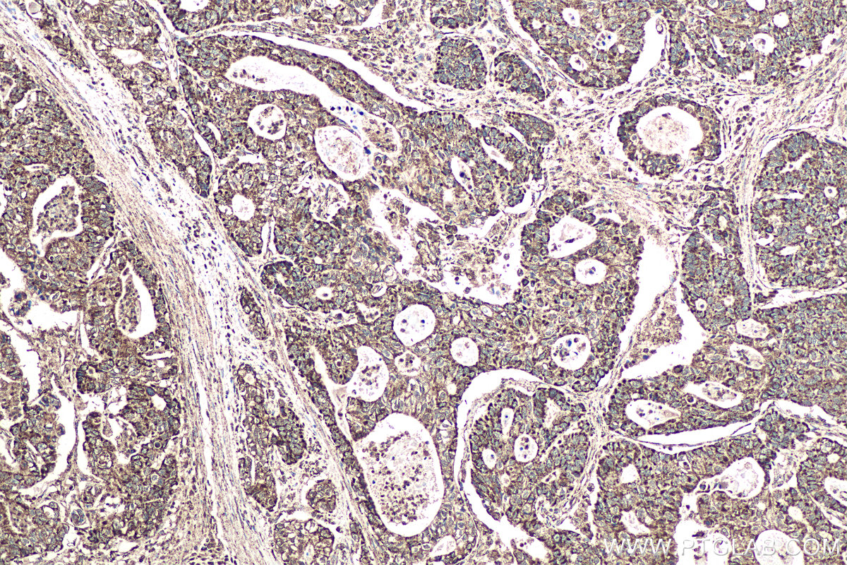 Immunohistochemical analysis of paraffin-embedded human stomach cancer tissue slide using KHC0960 (ATP5D IHC Kit).
