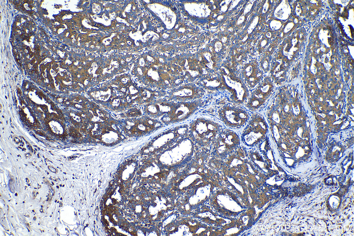 Immunohistochemical analysis of paraffin-embedded human breast cancer tissue slide using KHC1354 (ATP6V1E1 IHC Kit).