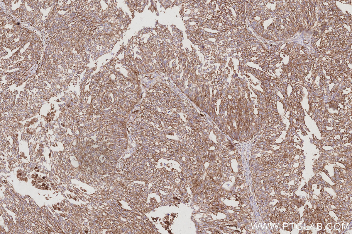 Immunohistochemical analysis of paraffin-embedded human ovary cancer tissue slide using KHC3027 (ATP6V1H IHC Kit). Immunohistochemical analysis of paraffin-embedded human ovary cancer tissue slide using KHC3027 (ATP6V1H IHC Kit).