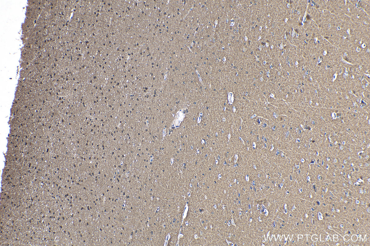 Immunohistochemical analysis of paraffin-embedded human gliomas tissue slide using KHC0290 (Alpha Synuclein IHC Kit).