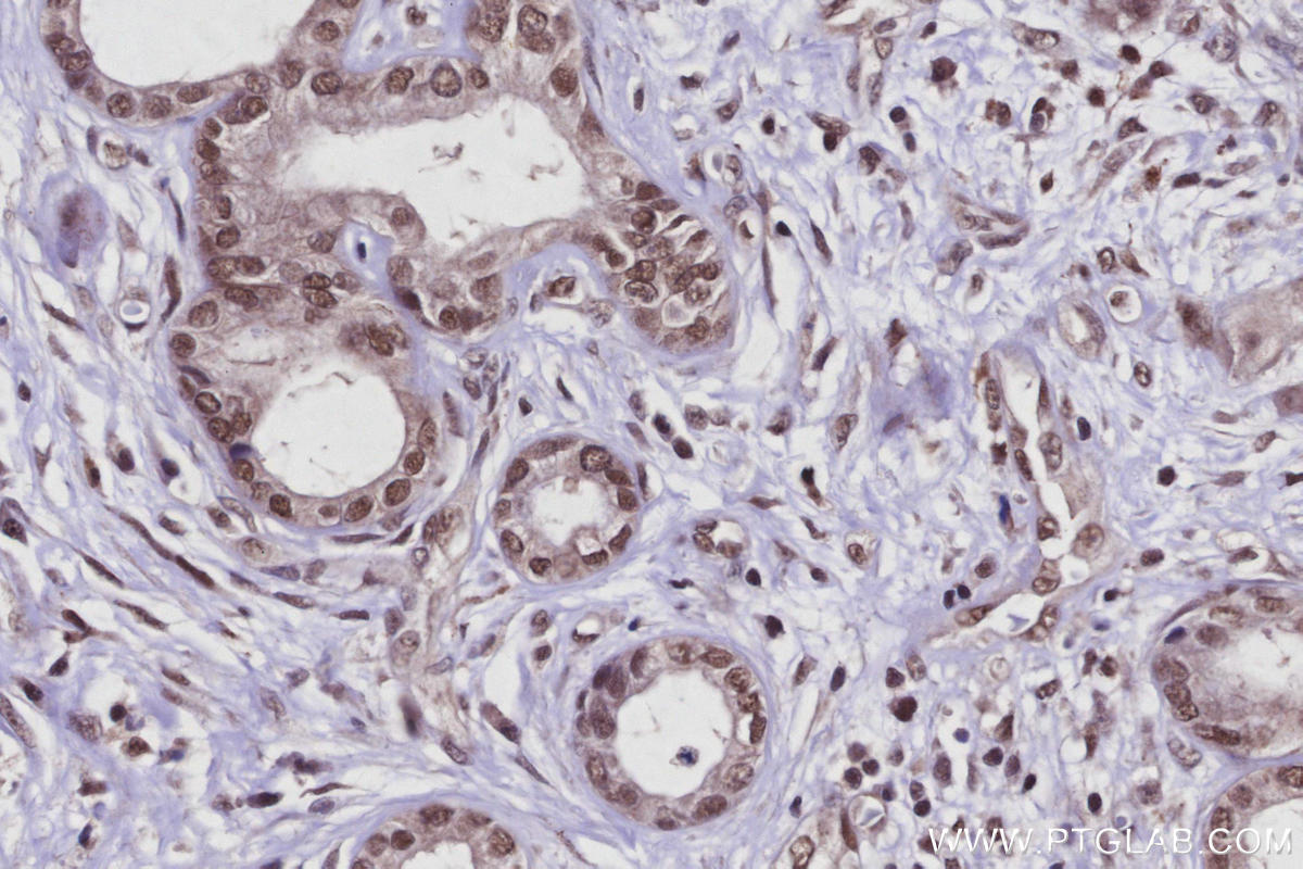 Immunohistochemical analysis of paraffin-embedded human pancreas cancer tissue slide using KHC2926 (Arp5/ACTR5 IHC Kit).