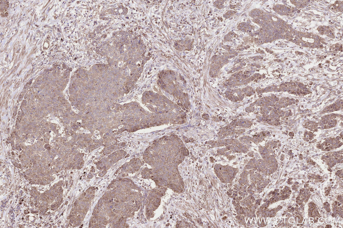 Immunohistochemical analysis of paraffin-embedded human stomach cancer tissue slide using KHC3299 (B3GNT7 IHC Kit).