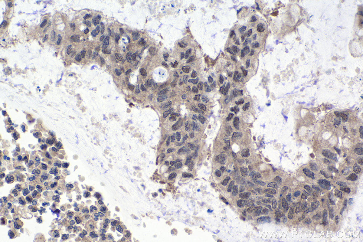 Immunohistochemical analysis of paraffin-embedded human colon cancer tissue slide using KHC1031 (BAG5 IHC Kit).