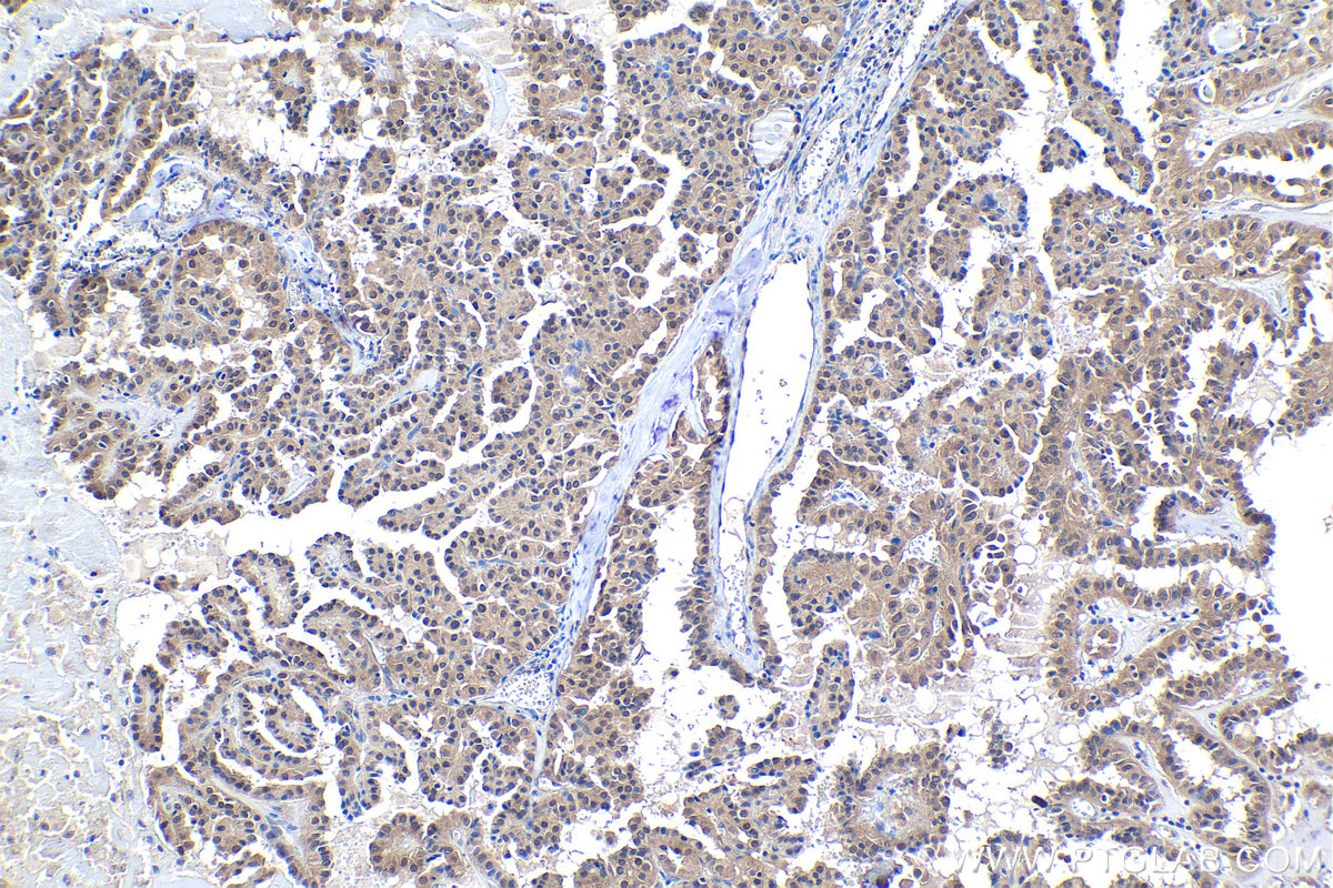 Immunohistochemical analysis of paraffin-embedded human thyroid cancer tissue slide using KHC1031 (BAG5 IHC Kit).