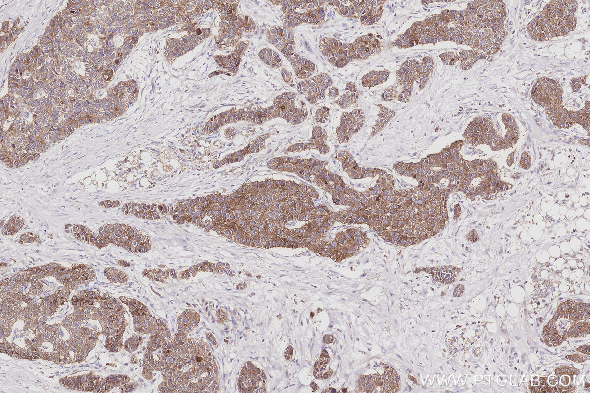 Immunohistochemical analysis of paraffin-embedded human stomach cancer tissue slide using KHC3010 (BAIAP2L1 IHC Kit). Immunohistochemical analysis of paraffin-embedded human stomach cancer tissue slide using KHC3010 (BAIAP2L1 IHC Kit).