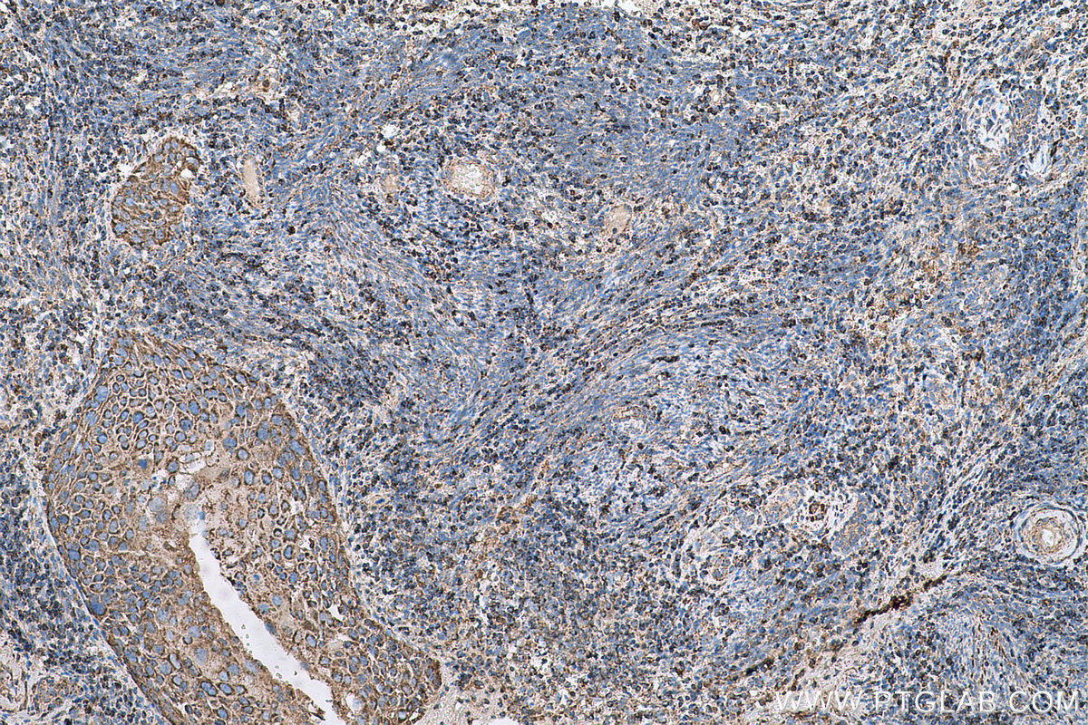 Immunohistochemical analysis of paraffin-embedded human cervical cancer tissue slide using KHC0605 (BAK IHC Kit).