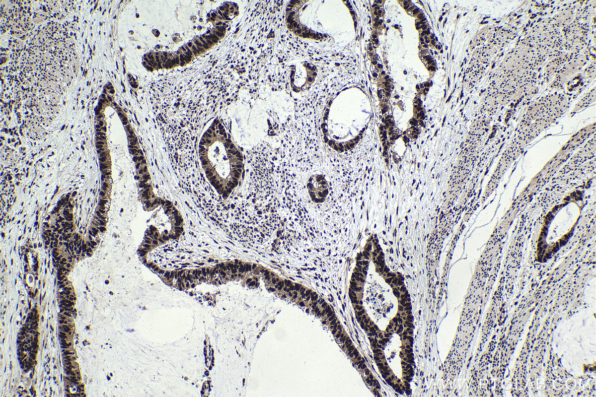 Immunohistochemical analysis of paraffin-embedded human urothelial carcinoma tissue slide using KHC1759 (BATF IHC Kit).