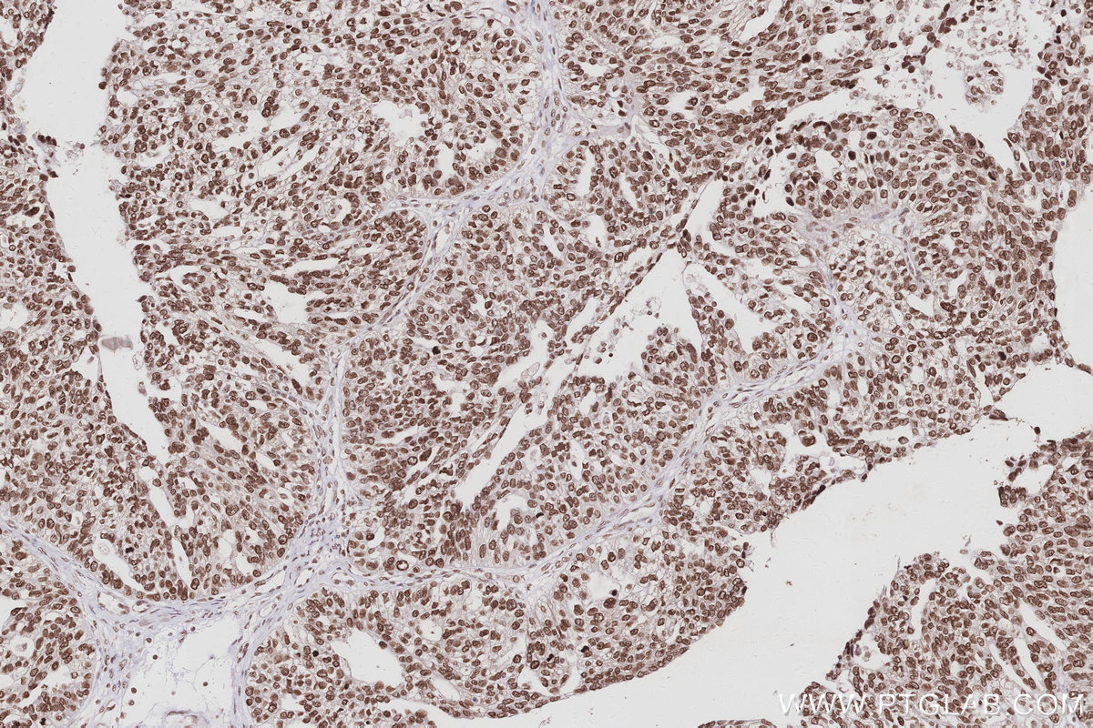 Immunohistochemical analysis of paraffin-embedded human ovary cancer tissue slide using KHC3013 (BAZ1B/WSTF IHC Kit).