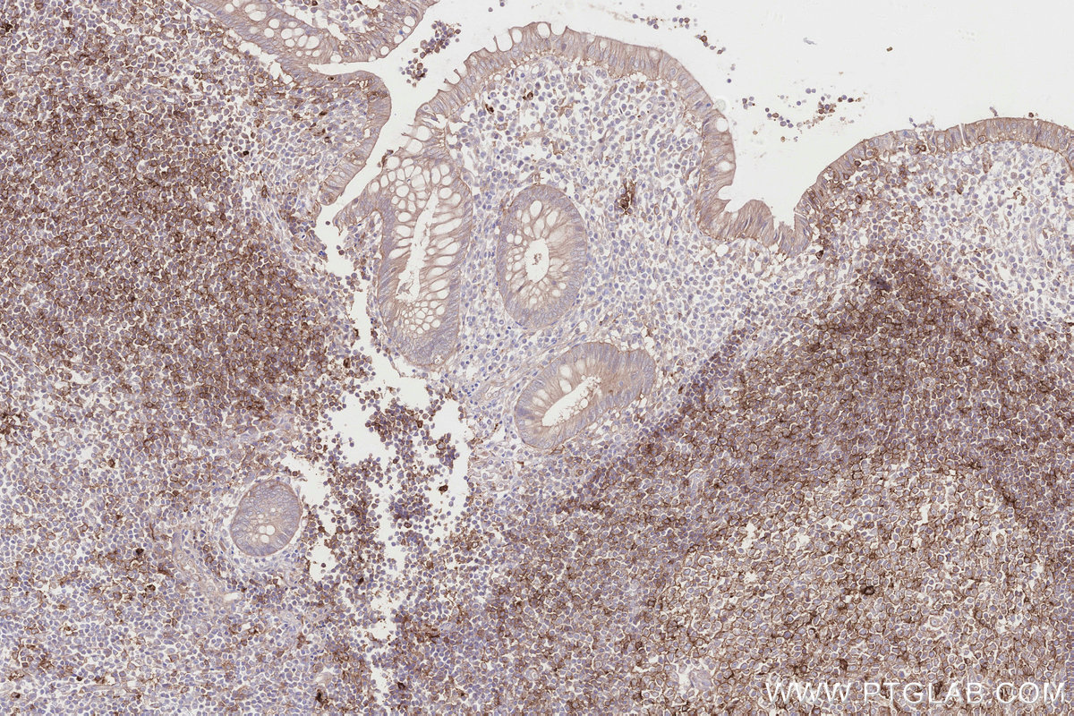Immunohistochemical analysis of paraffin-embedded human appendicitis tissue slide using KHC2826 (BBS4 IHC Kit).