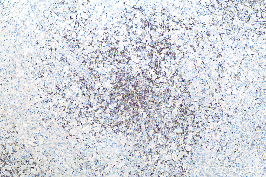 Immunohistochemical analysis of paraffin-embedded human lymphoma tissue slide using KHC0012 (BCL2 IHC Kit).