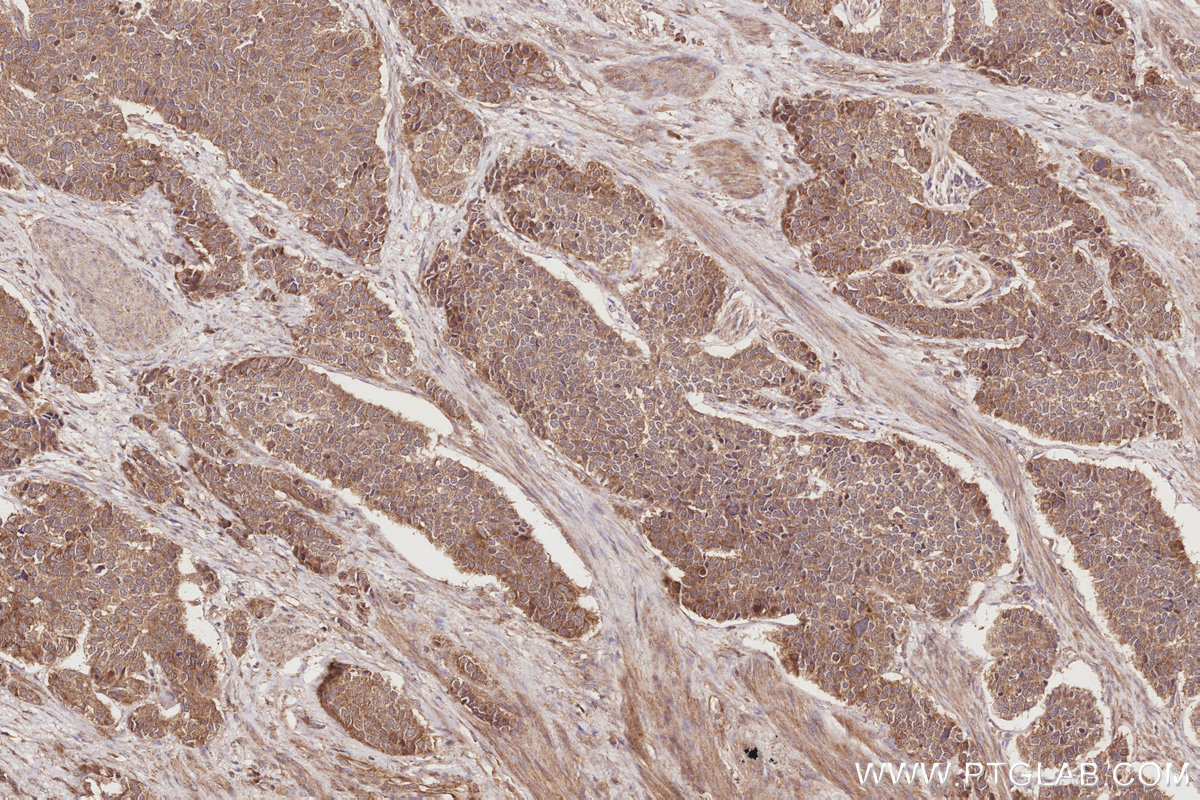 Immunohistochemical analysis of paraffin-embedded human stomach cancer tissue slide using KHC2869 (BEGAIN IHC Kit).