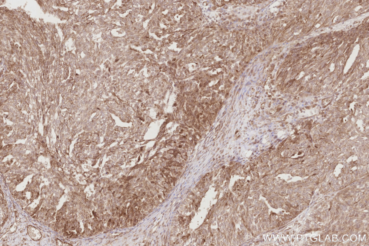 Immunohistochemical analysis of paraffin-embedded human ovary cancer tissue slide using KHC2884 (BEX1/2 IHC Kit). Immunohistochemical analysis of paraffin-embedded human ovary cancer tissue slide using KHC2884 (BEX1/2 IHC Kit).