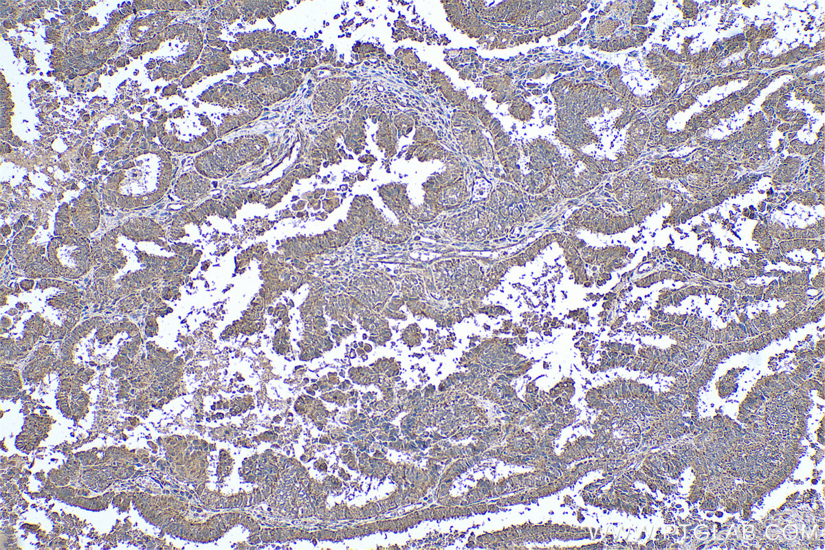 Immunohistochemical analysis of paraffin-embedded human ovary tumor tissue slide using KHC0620 (cIAP1 IHC Kit).