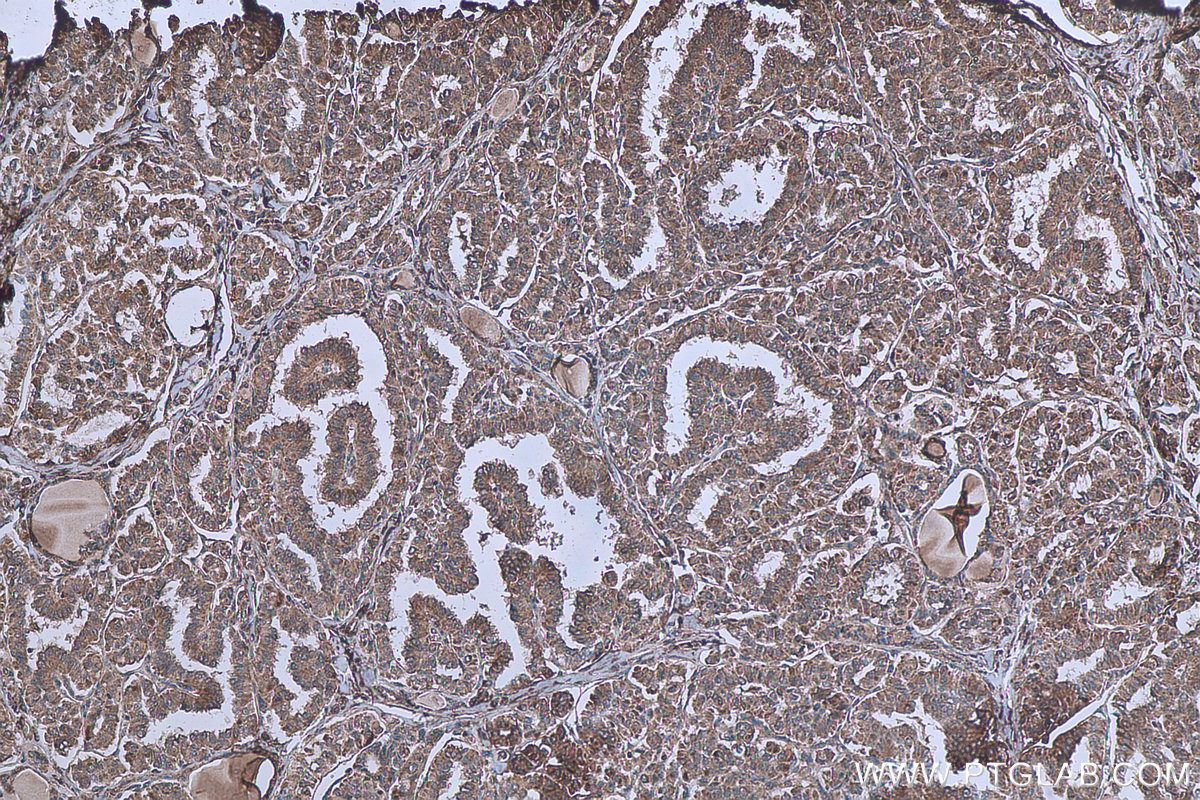 Immunohistochemical analysis of paraffin-embedded human thyroid cancer tissue slide using KHC0620 (cIAP1 IHC Kit).