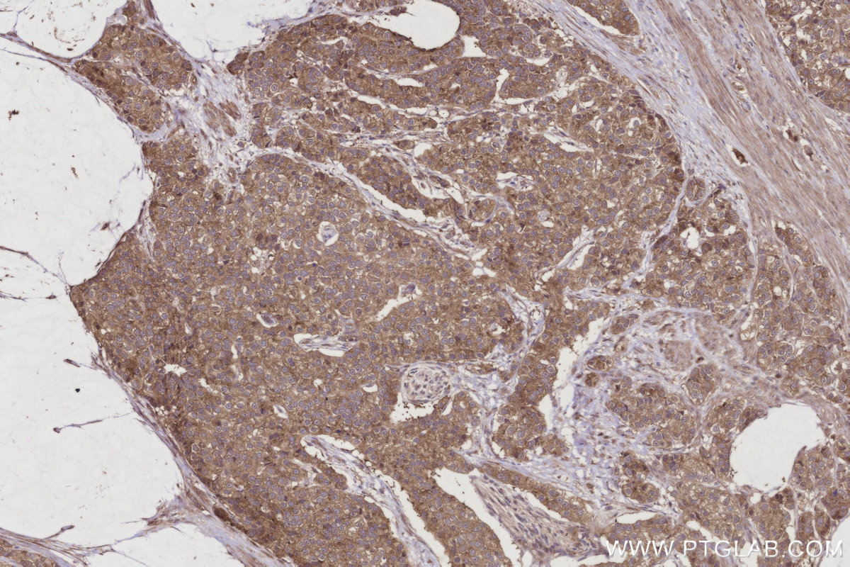 Immunohistochemical analysis of paraffin-embedded human stomach cancer tissue slide using KHC2946 (BIRC6 IHC Kit).